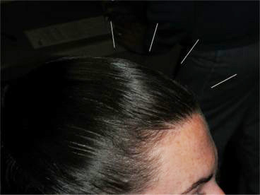 Acupuncture for Stress Reduction
